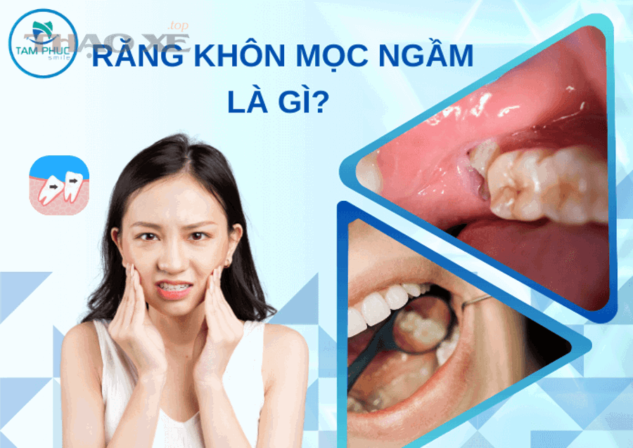 Những nhóm lỗi nào khiến ngàm nhựa dễ gãy nhất?