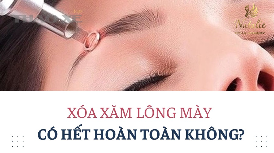 xoa xam long may co het hoan toan khong