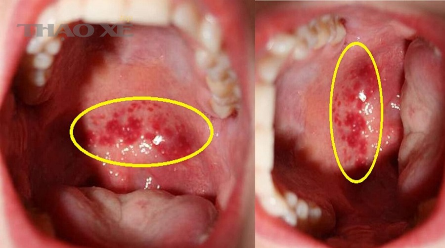 Cổ hút và hệ nạp liên quan đến độ sạch của họng ga